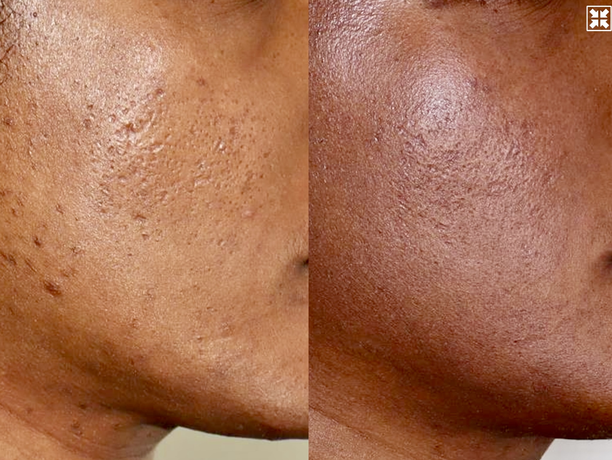 Acne Scarring – Patient Case #115 Combined Image