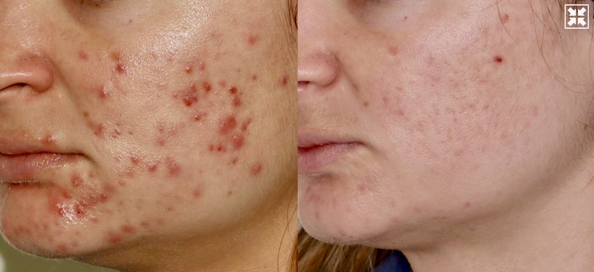 Acne Treatment – Patient Case #114 Combined Image