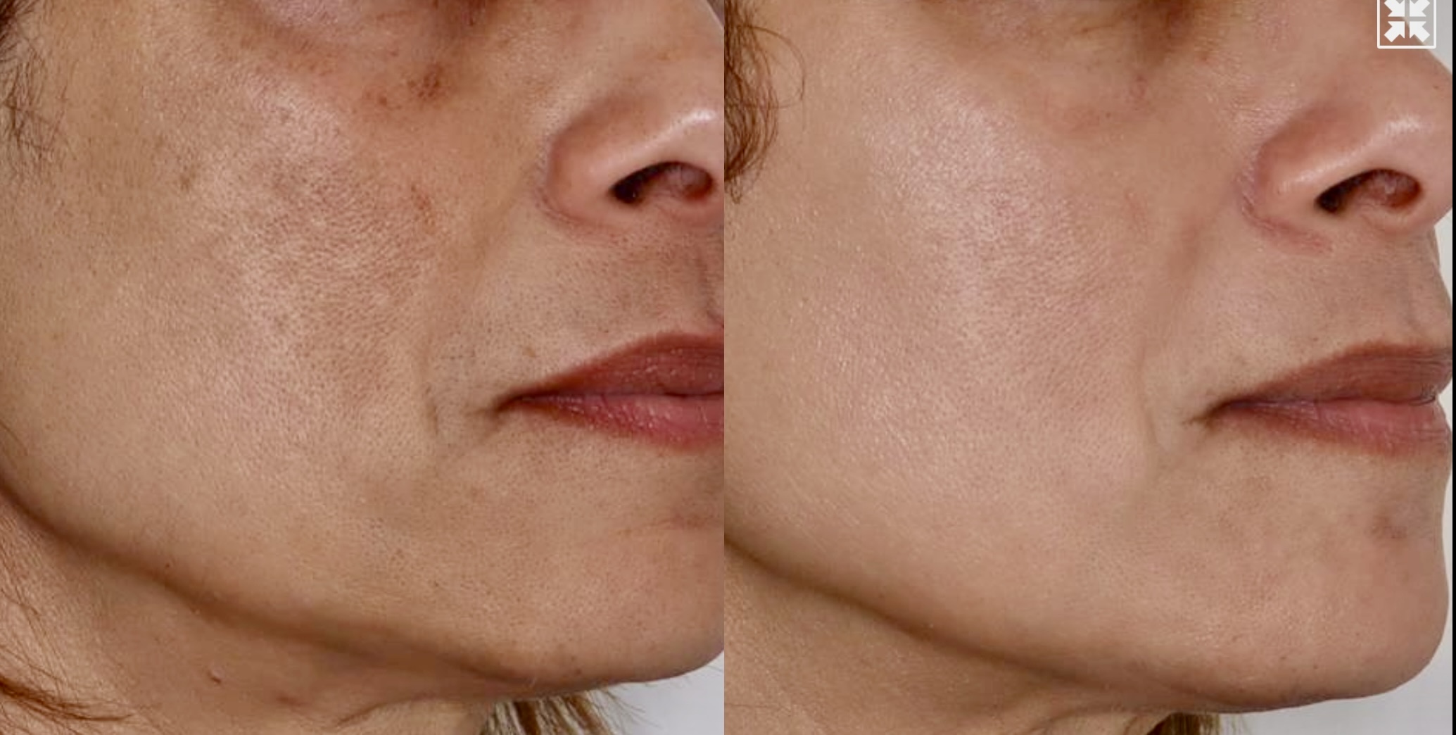 PicoSure – Patient Case #118 Combined Image