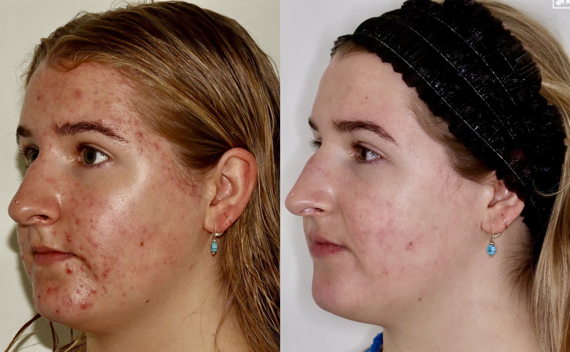 Acne Treatment – Patient Case #117 Combined Image