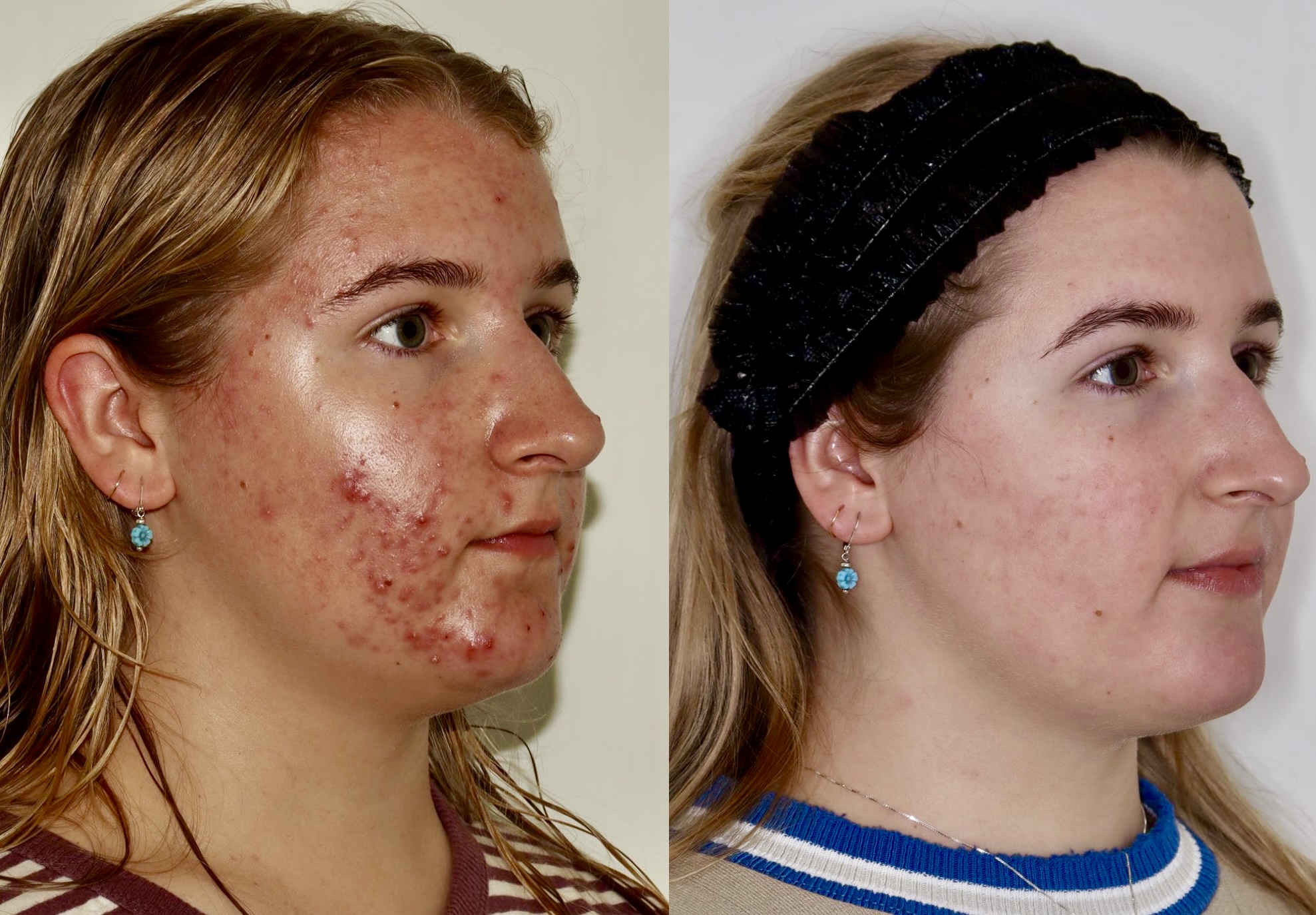 Acne Treatment – Patient Case #117 Combined Image