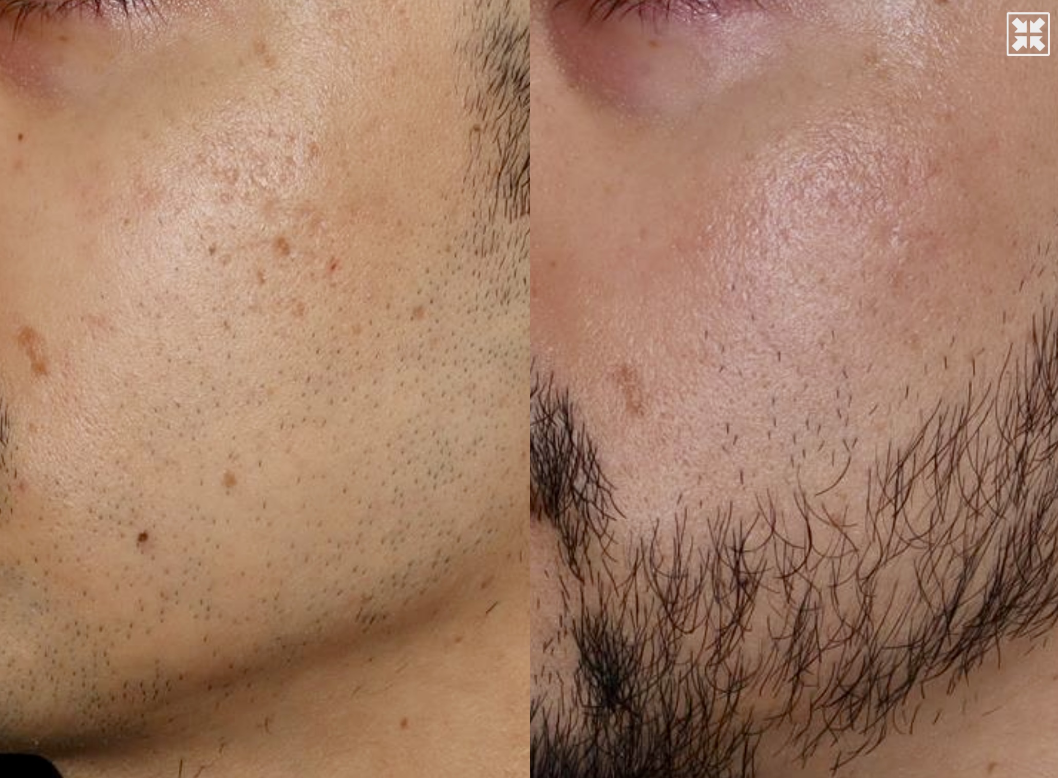 Acne Scarring – Patient Case #116 Combined Image
