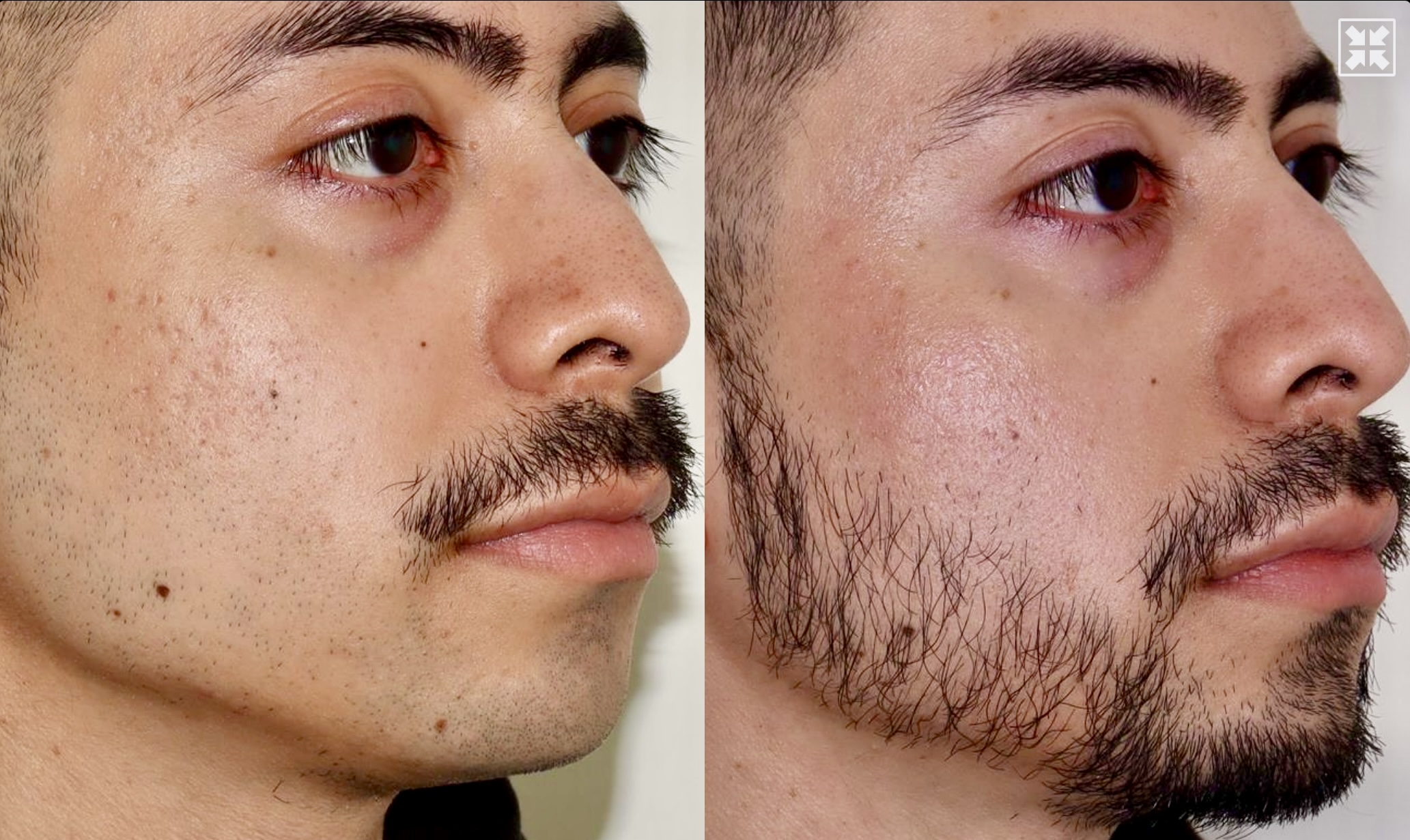 Acne Scarring – Patient Case #116 Combined Image