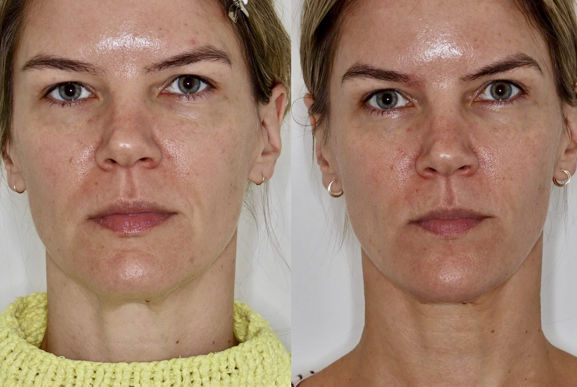 Radiesse – Patient Case #119 Combined Image