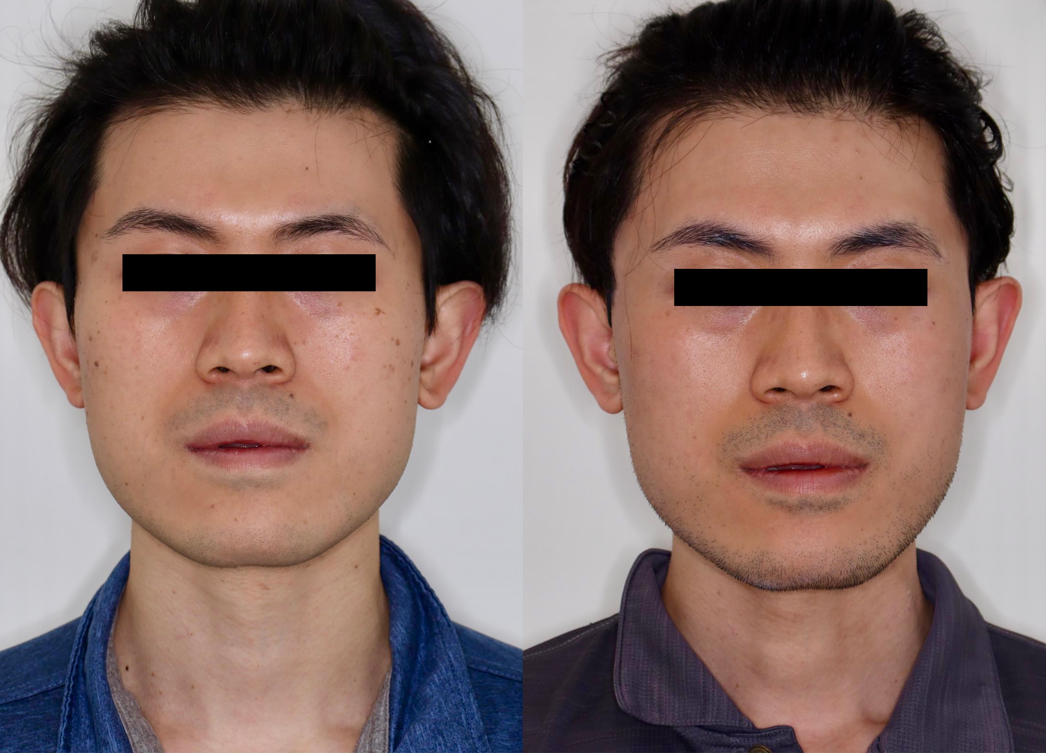 PicoSure – Patient Case #120 Combined Image
