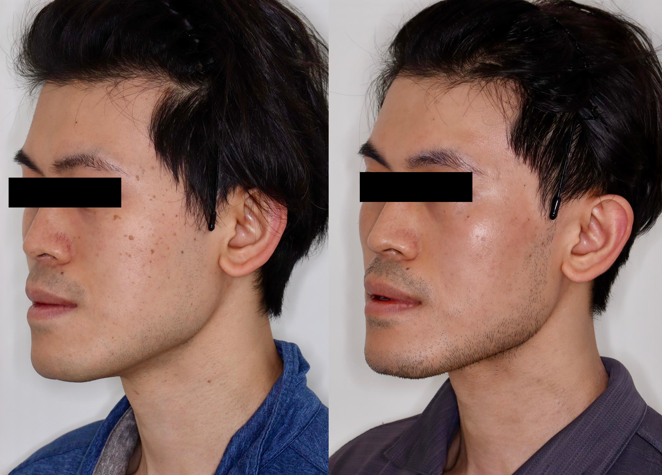 PicoSure – Patient Case #120 Combined Image