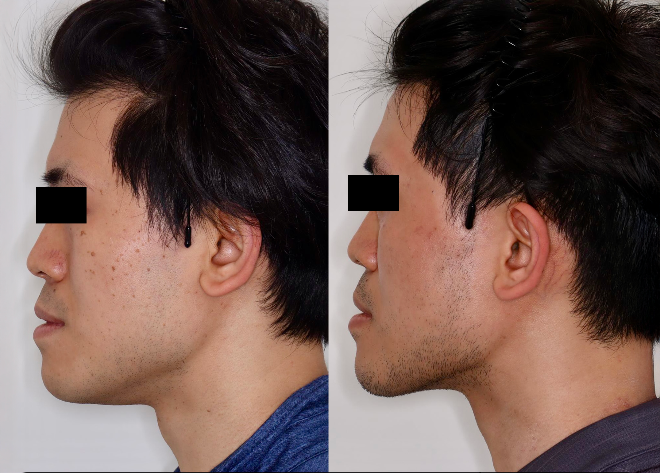 PicoSure – Patient Case #120 Combined Image