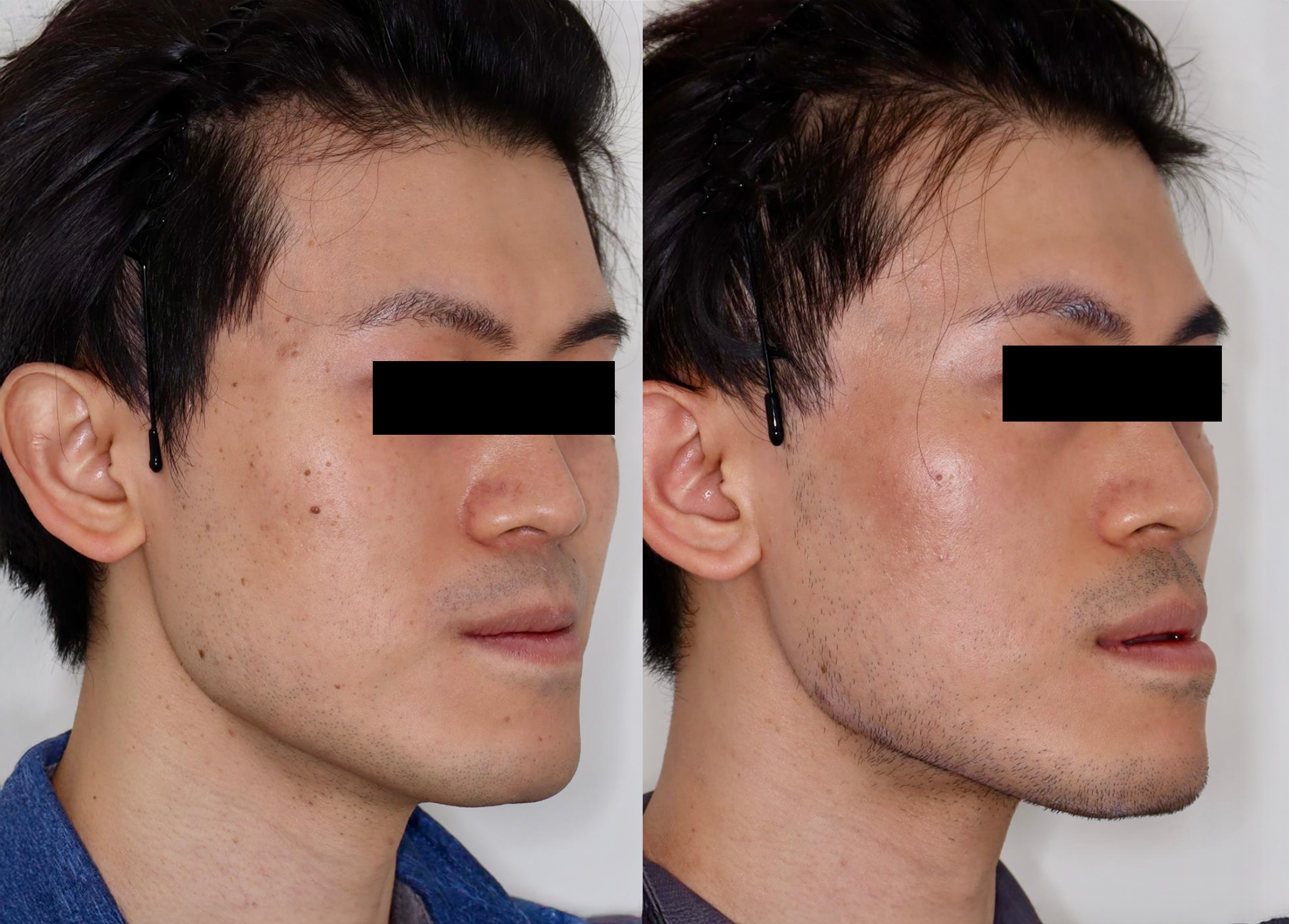 PicoSure – Patient Case #120 Combined Image