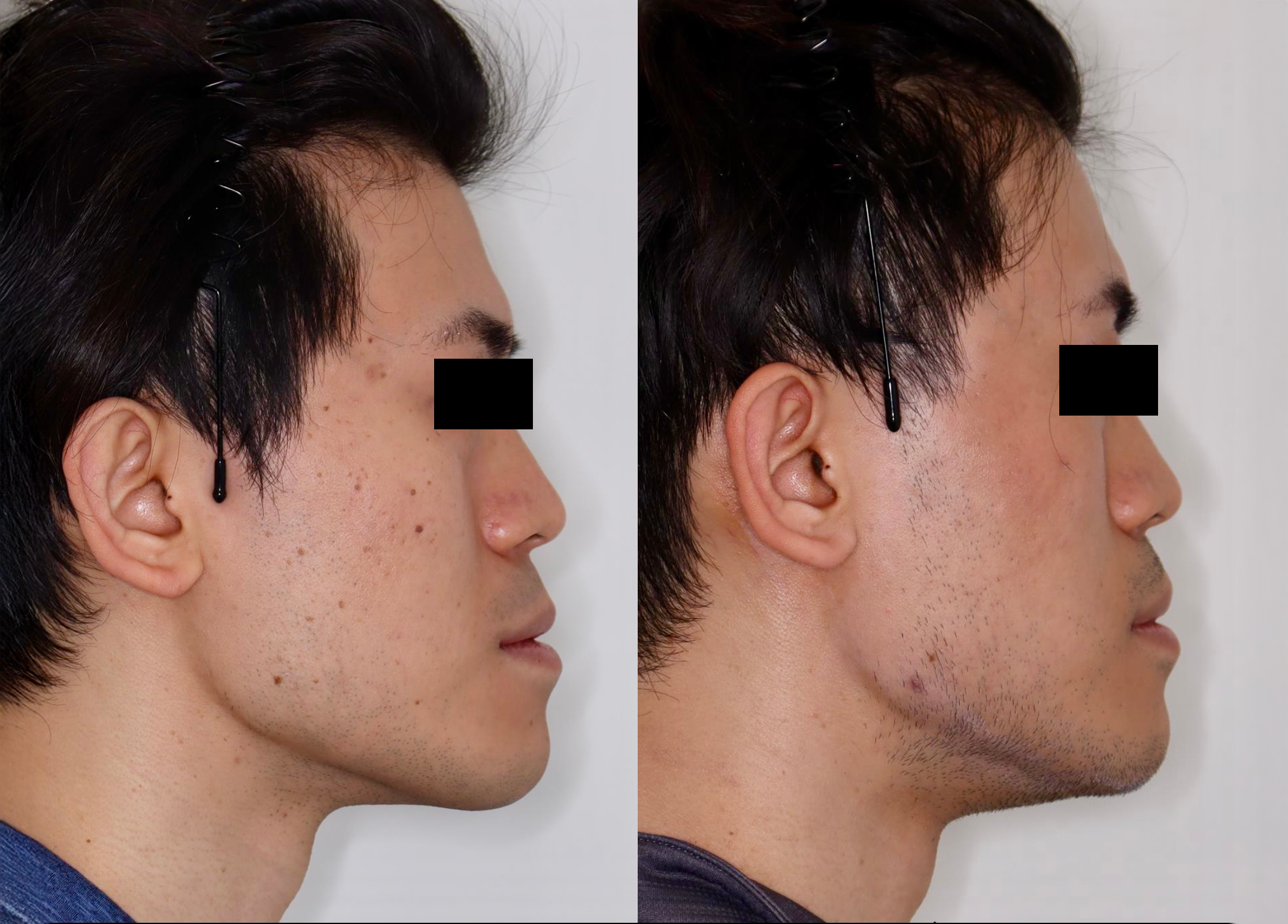 PicoSure – Patient Case #120 Combined Image