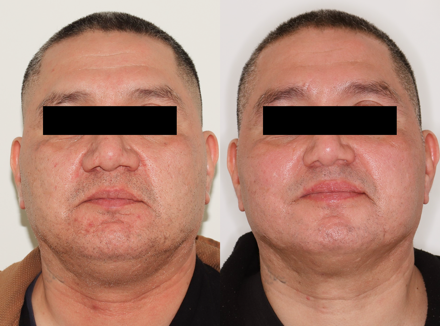 Acne Scarring – Patient Case #123 Combined Image