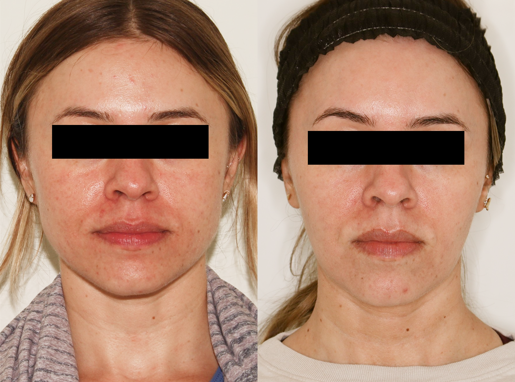 Laser – Patient Case #124 Combined Image
