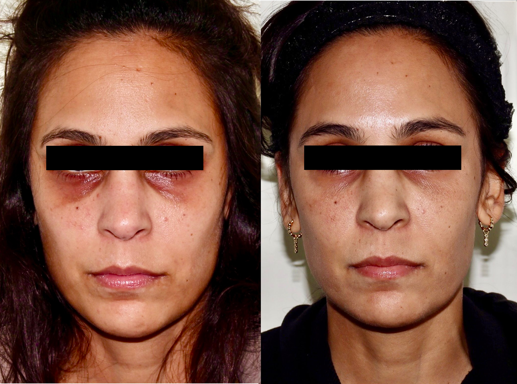 Laser – Patient Case #125 Combined Image