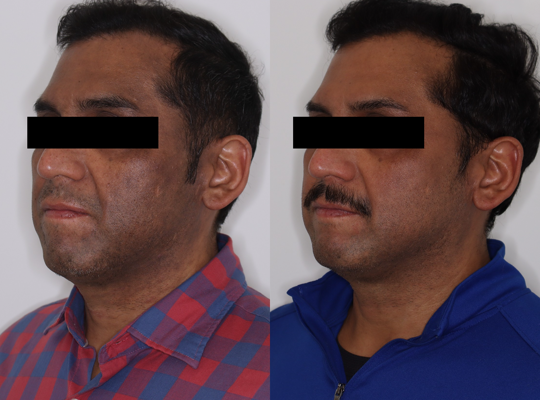 PicoSure – Patient Case #122 Combined Image