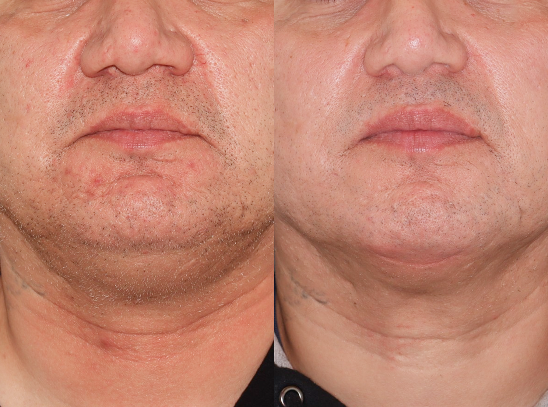 Acne Scarring – Patient Case #123 Combined Image