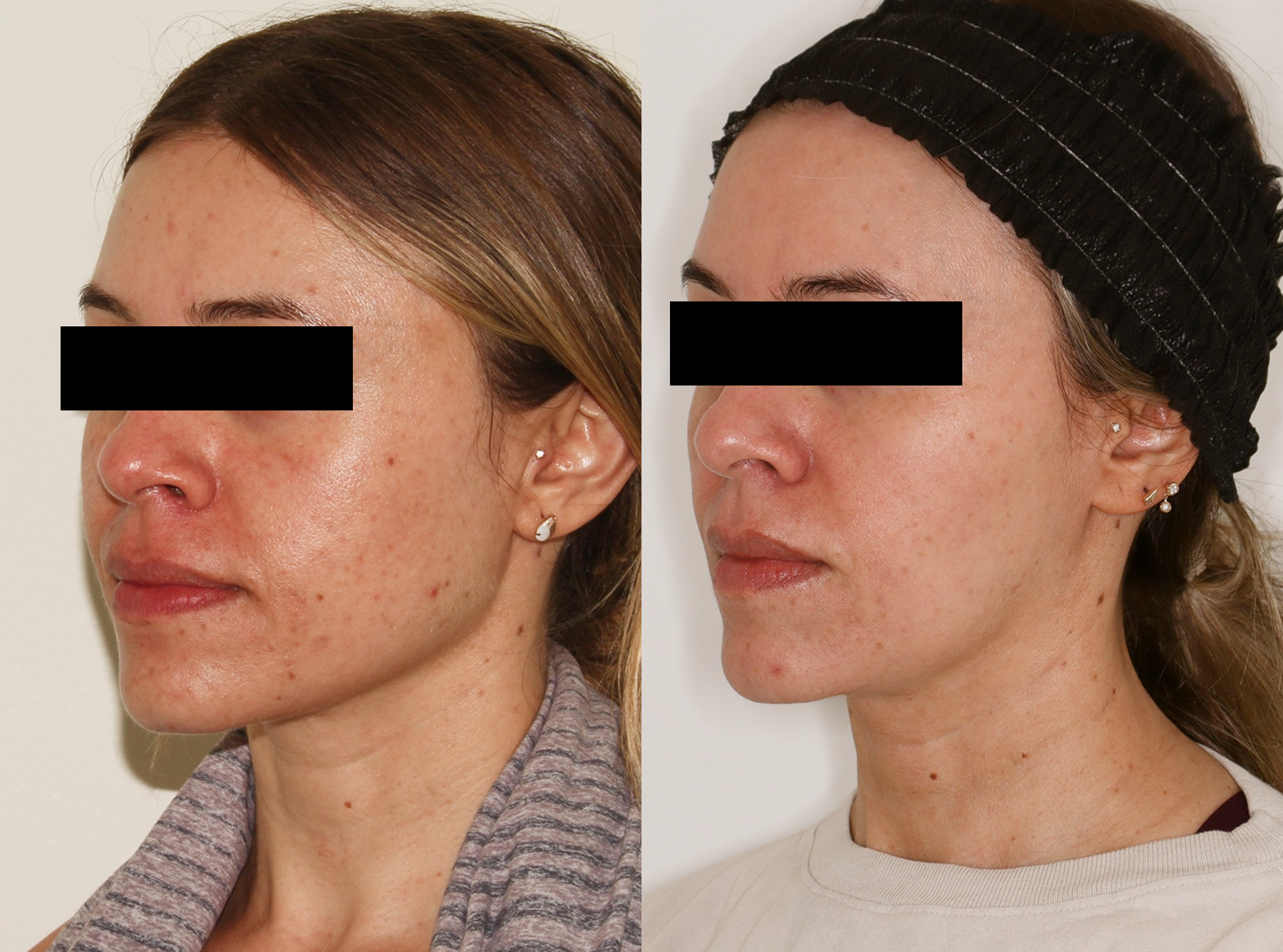 Laser – Patient Case #124 Combined Image