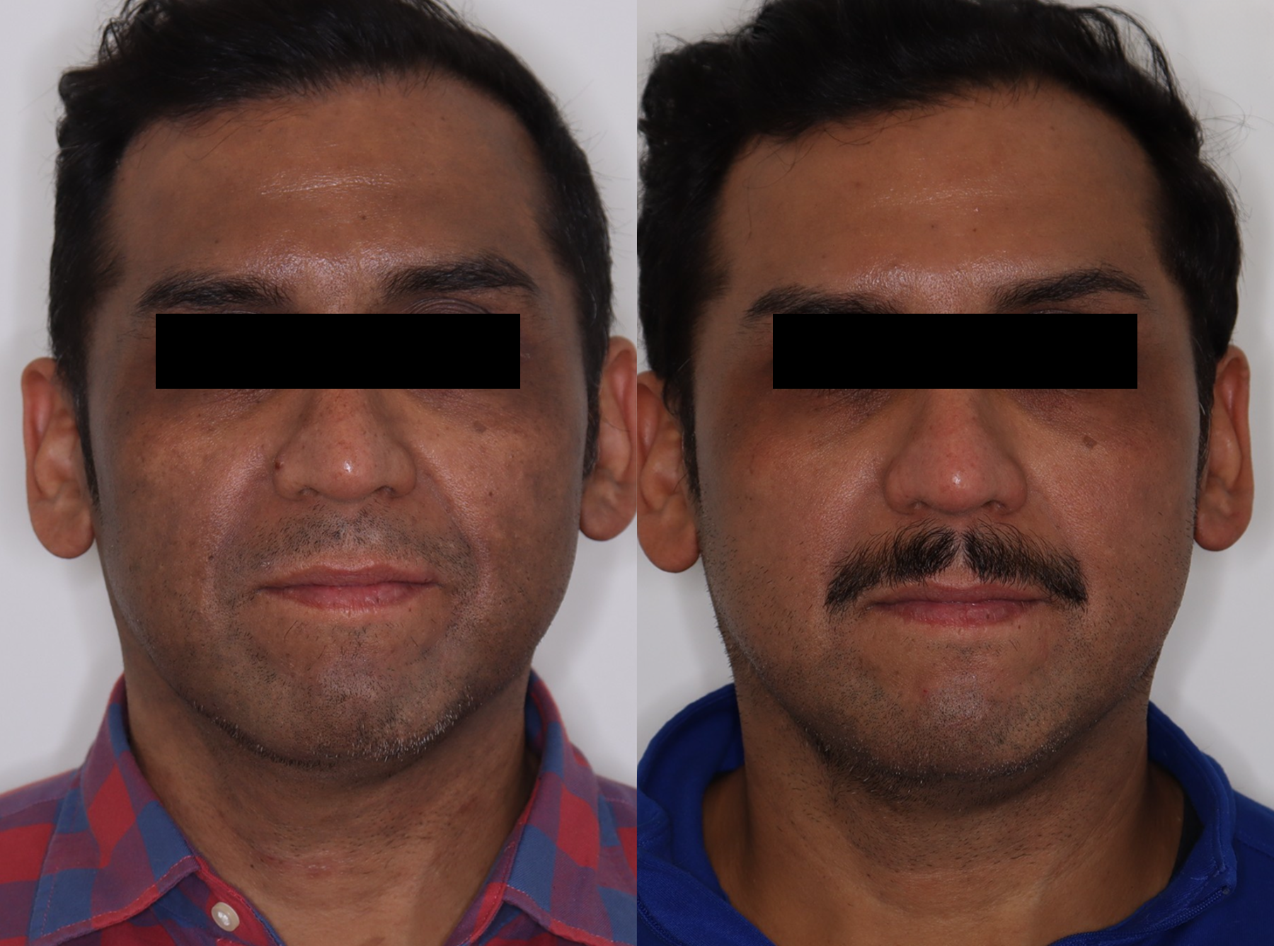 PicoSure – Patient Case #122 Combined Image