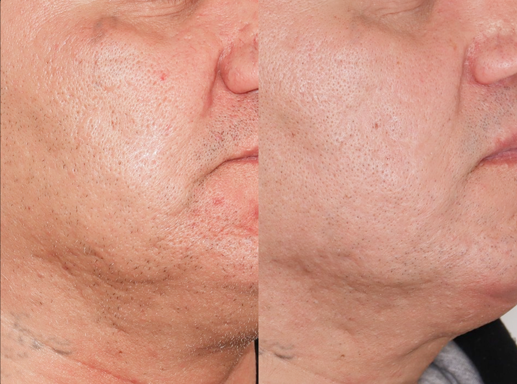 Acne Scarring – Patient Case #123 Combined Image