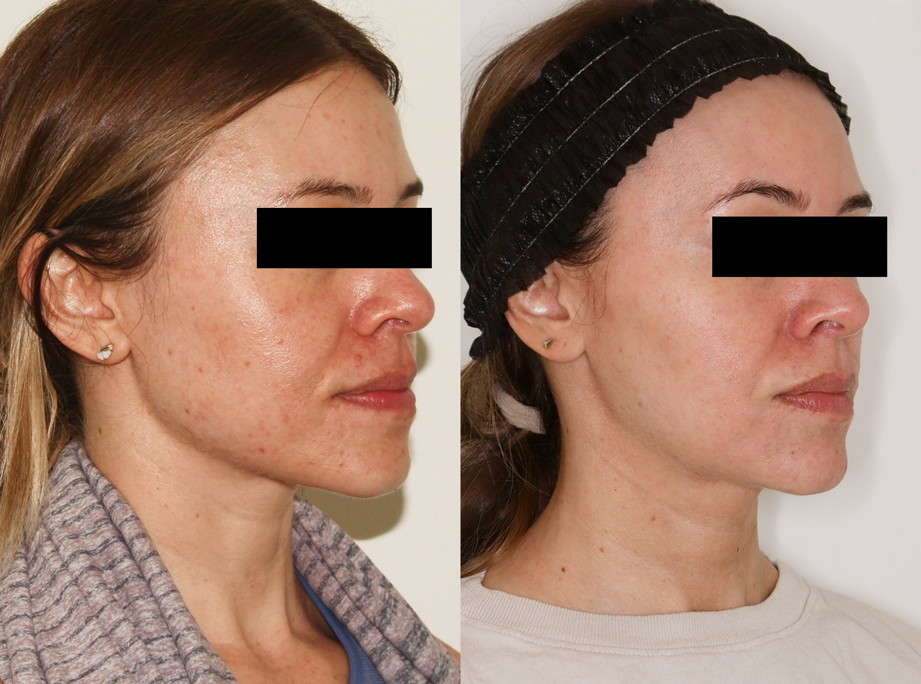 Laser – Patient Case #124 Combined Image