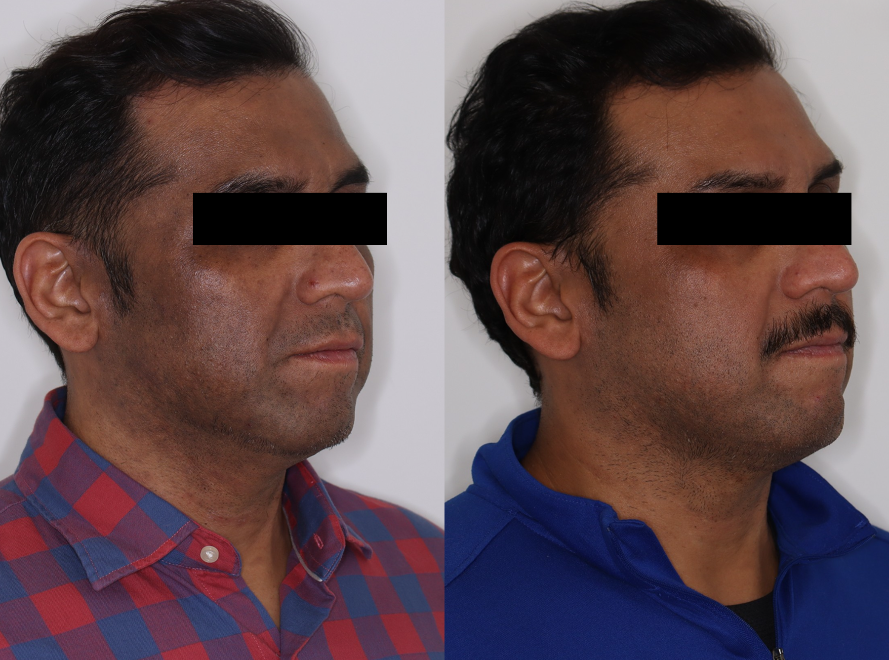 PicoSure – Patient Case #122 Combined Image