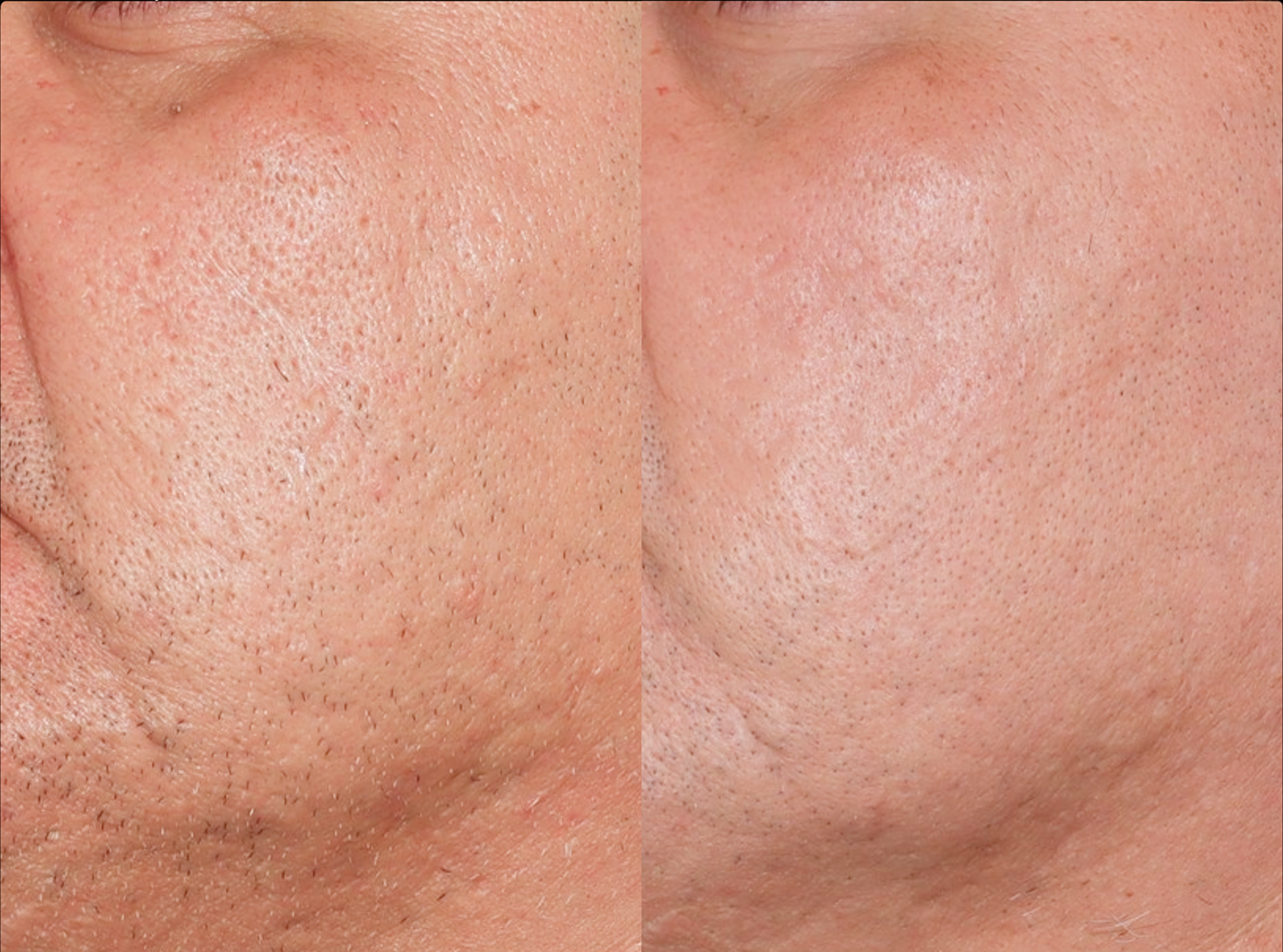 Acne Scarring – Patient Case #123 Combined Image