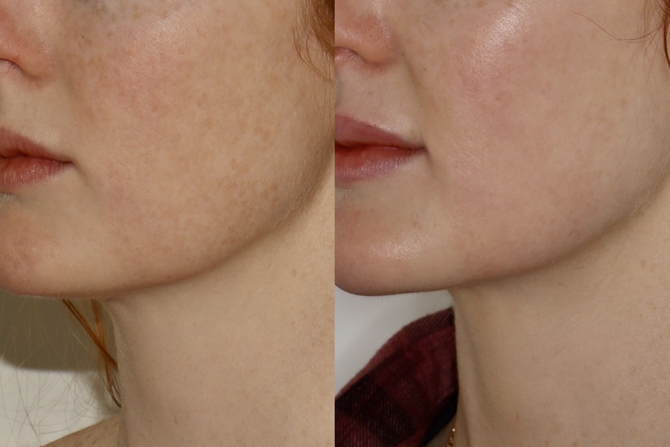Laser – Patient Case #126 Combined Image