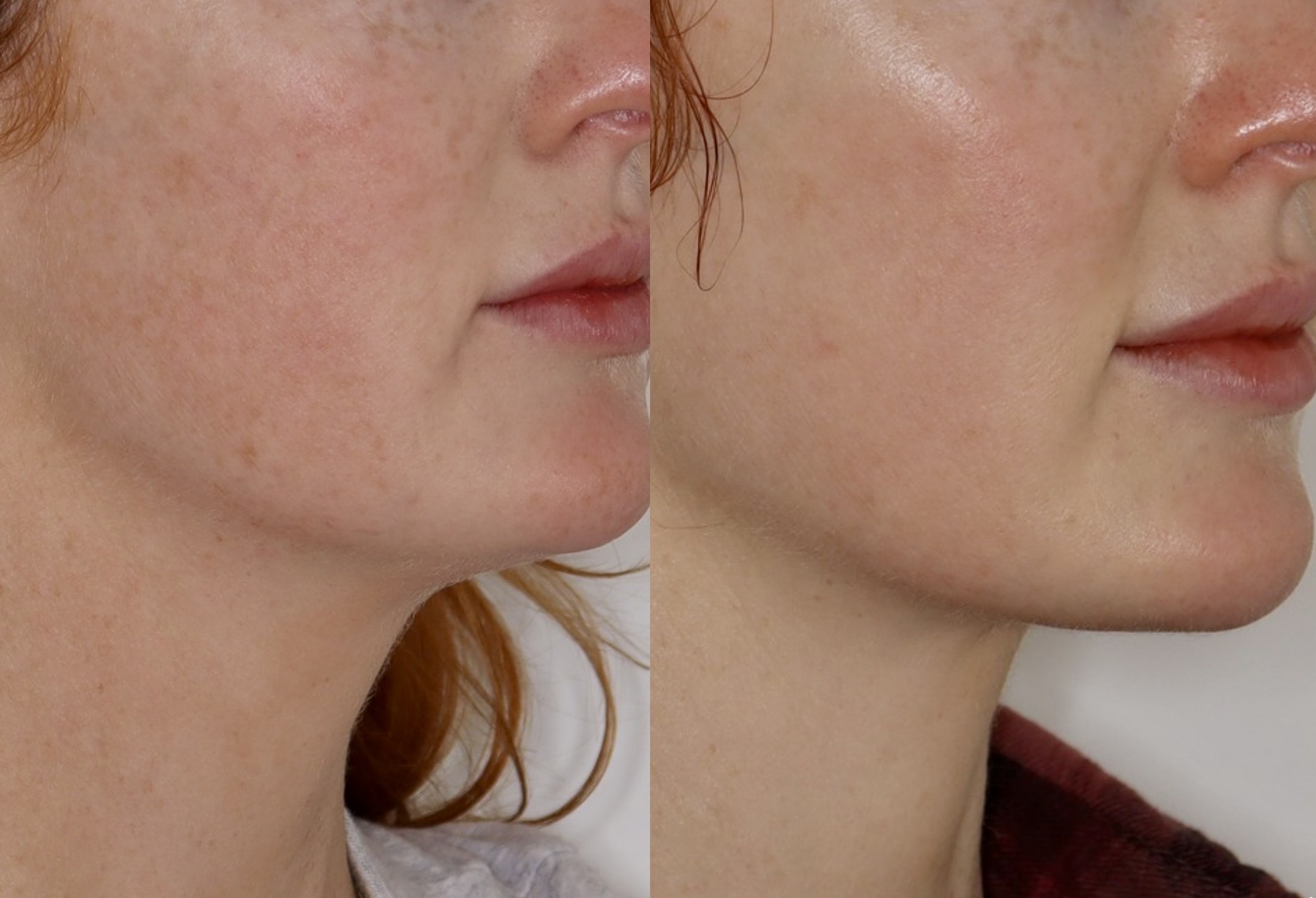 Laser – Patient Case #126 Combined Image