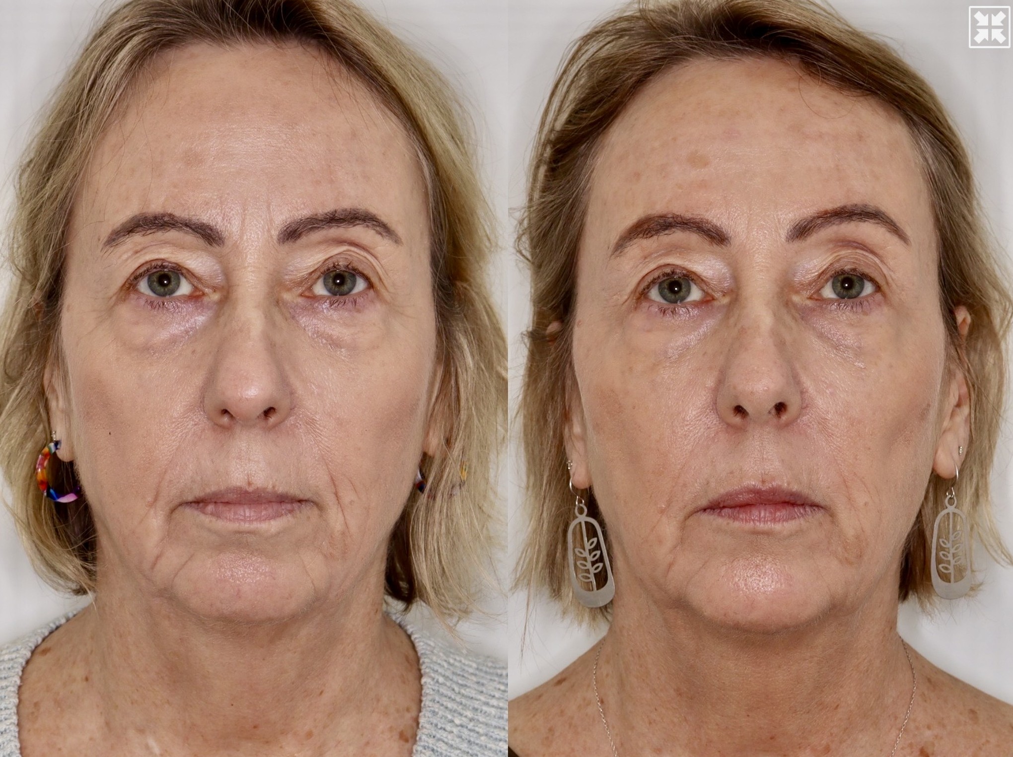 Dermal Fillers & Laser – Patient Case #121 Combined Image
