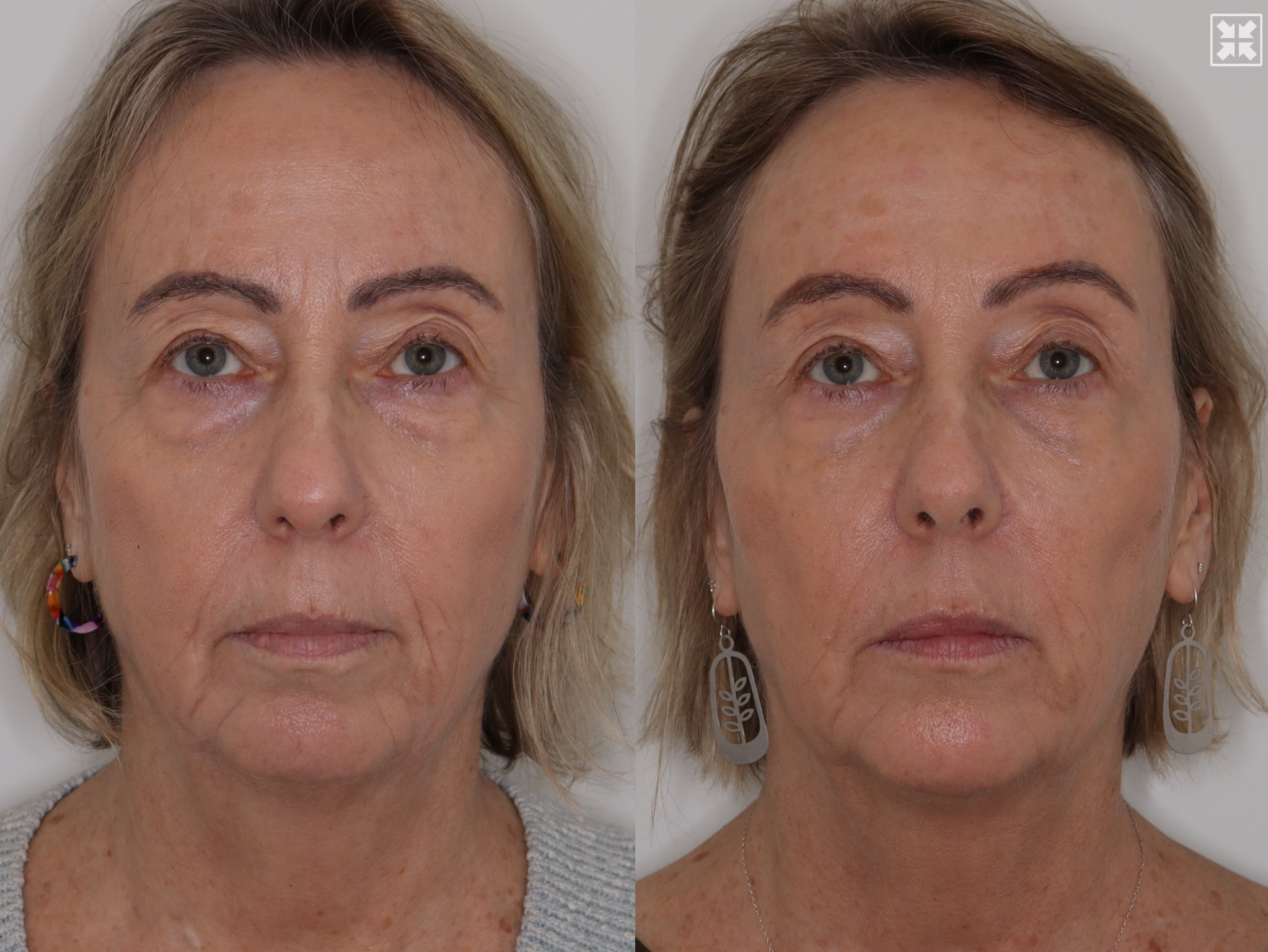 Dermal Fillers & Laser – Patient Case #107 Combined Image