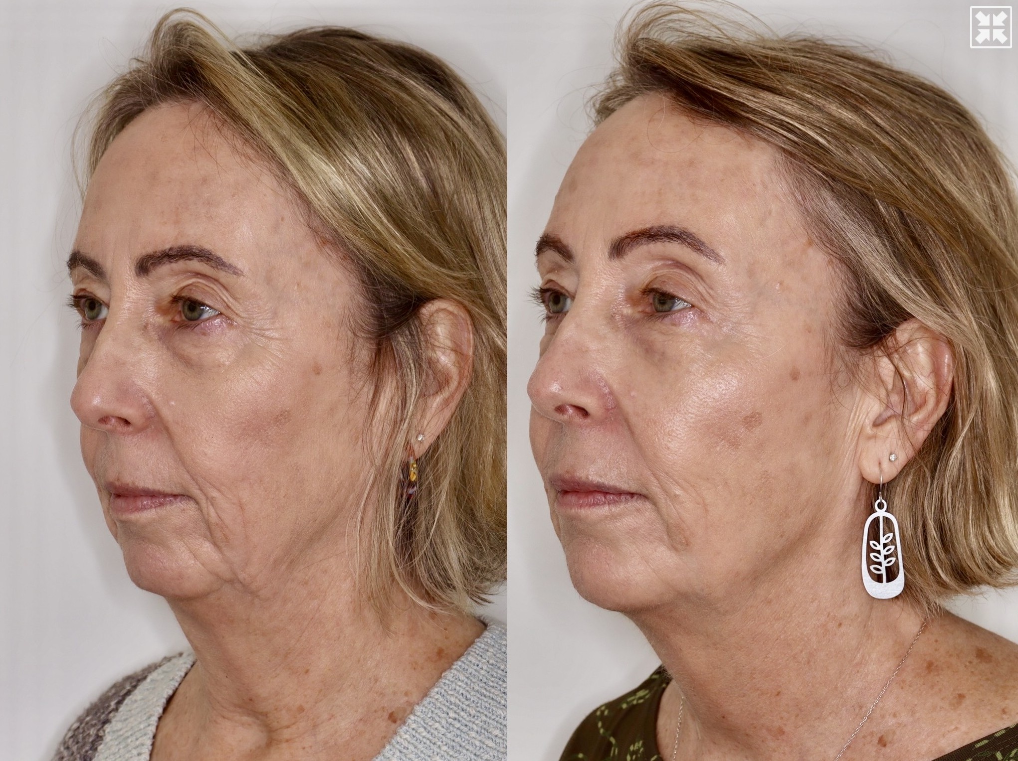 Dermal Fillers & Laser – Patient Case #121 Combined Image
