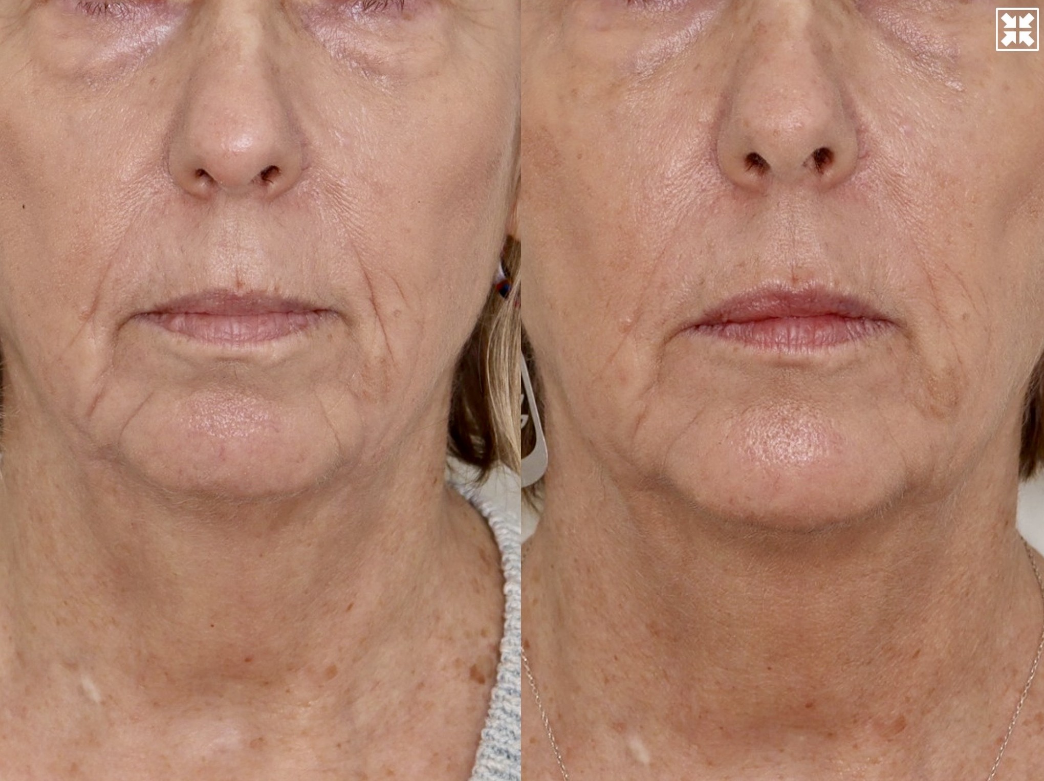 Dermal Fillers & Laser – Patient Case #121 Combined Image