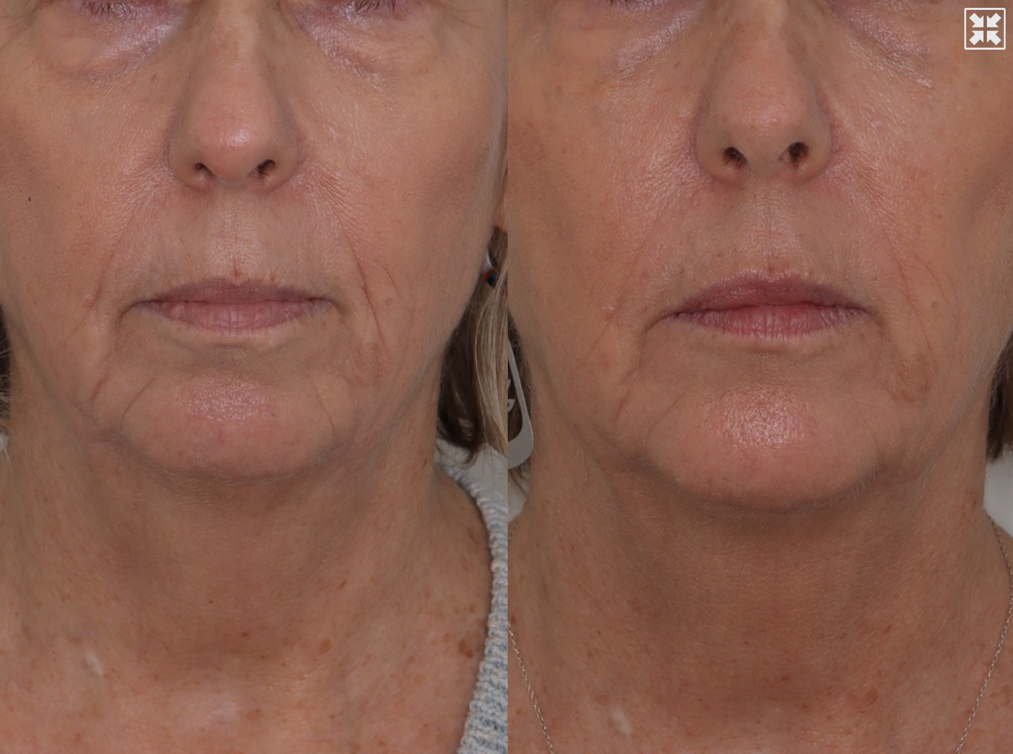 Dermal Fillers & Laser – Patient Case #107 Combined Image